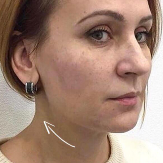 image after the procedure