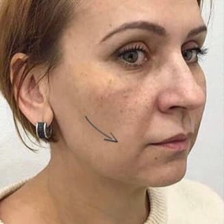 Before procedure